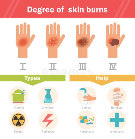 Degree of skin burns. Vector. stock illustration Types Of Burns, Burn Injury, Skin Burns, Medical Terms, Vector Cartoon, Flat Illustration, Vector Stock, Illustration Vector, Simple Nails