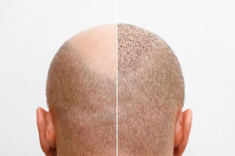 Prp For Hair, Hair Transplant Women, Restore Hair Health, Prp Hair, 3d Graffiti Street Art, Hair Transplant Procedure, Before And After Hair, Photo Hair, 3d Graffiti