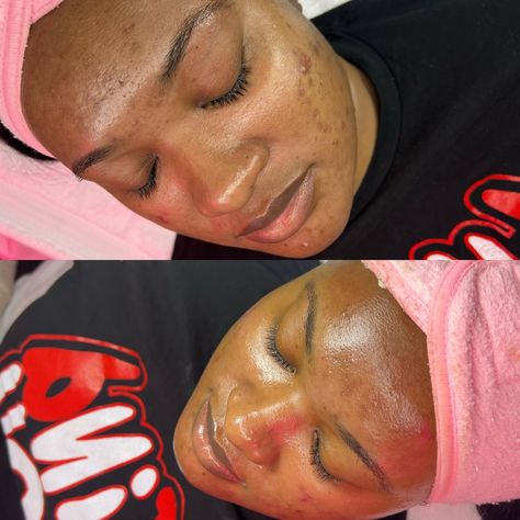 I just love before and after facial glows! This beautiful canvas received our Hydro Facial glow and it’s a glow like none other! We have our treatments every 3 weeks and her at home regimen dedicated to healing her acne from the inside out 🩷. Can you see the difference in the before and after? You can book this same service at PRETTYAESTHETICSSTUDIO.COM June appointments available ✨ Follow @prettyaesthetiics for more content 🫧. #dallas #dallasesthetician #skinspecialist #acne #hydrofacial Hydro Facial, Skin Specialist, Appointments Available, Esthetician, 3 Weeks, Just Love, Dallas, Inside Out, Facial