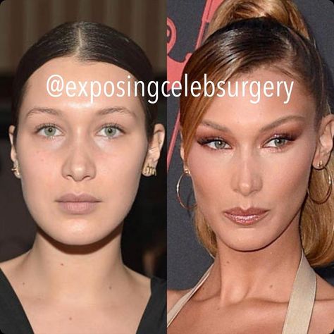 Why celebrities like Bella Hadid, Ariana Grande, and Kylie Jenner are suspected of having Botox brow lifts. Fox Eye Surgery, Botox Brow Lift, Thread Lift, Fox Eyes, Brow Lift, Eye Surgery, Eye Lift, Gigi Bella, Don't Compare