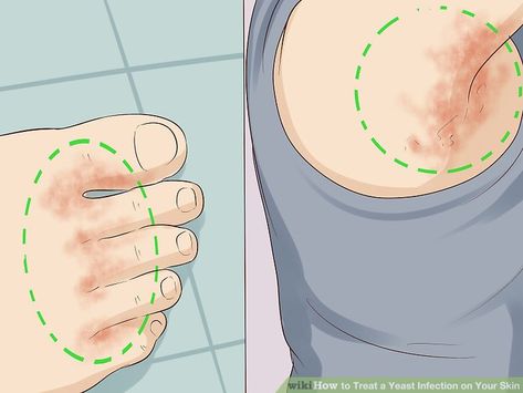 Yeast Infection On Skin, Yeast Infection Symptoms, Baking Soda Bath, Herbal Drinks, Skin Remedies, Homeopathic Remedies, Beauty Treatments, Yeast, Get One