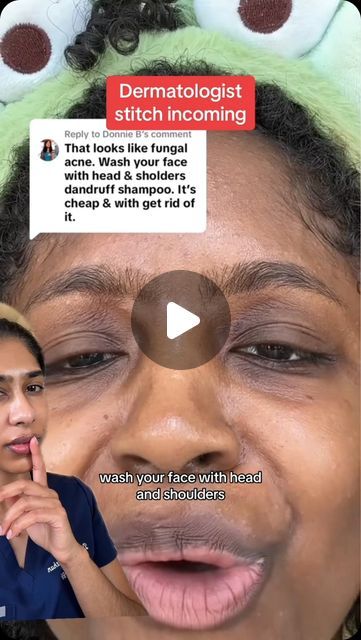 Dr. Neera Nathan on Instagram: "Head & Shoulders is not just for dandruff. It contains pyrithione zinc, which is anti-fungal and antibacterial, making it one of the cheapest home remedies for a variety of skin conditions.

For fungal acne: “Fungal” acne is actually malassezia (pityrisporum) folliculitis and is caused by the same yeast as dandruff. It presents as tiny, itchy monomorphic bumps on the forehead and hairline. H&S can be used as a face wash to help clear this condition. To use as a face wash, lather it on the face, leave it on for 2 minutes, then rinse off. Use 2-3x per week. 

For seborrheic dermatitis: Seborrheic dermatitis is dry, flaky skin that occurs in between/around the eyebrows, on the side of the nose & behind the ears. It is related to dandruff. H&S can be used as a f Forehead Acne Home Remedies, Head And Shoulders For Acne, Tiny Bumps On Forehead, Tiny Bumps On Face, Dry Flaky Skin On Face, Dry Skin Remedies For Face, Forehead Acne Cause, Flaky Skin On Face, Eyebrow Dandruff