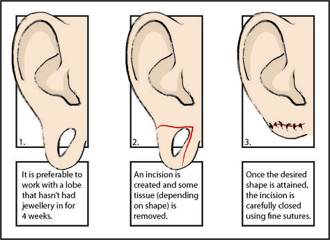 Surgery for stretched ears. Ear Surgery, Lgbtq Stuff, Stretched Ear, Piercing Inspo, Cool Piercings, Body Modification, Stretched Ears, Vsco Filter, Body Modifications