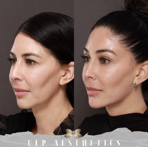 Can Dermal Fillers Get Rid Of My Jowls Pre Jowl Sulcus Filler, Check Filler Before And After, Filler For Jowls, Face Balancing Fillers, Facial Balancing Filler, Chin Fillers Before After, Face Injections, Chin Filler, Cosmetic Fillers