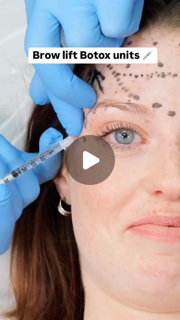 Dr Tim Pearce on Instagram: "Many of you ask how many Botox units I use for a subtle brow lift. Keep watching to find out. 

Only one week left until my free Botox webinar! If you’re feeling unsure about offering advanced treatments, this is the perfect opportunity to boost your confidence. Comment “TOX” for more info!" Botox For Eyebrow Lift, Botox For Hooded Eyelids, Eyebrow Lift Botox Before And After, Botox Brow Lift Before And After, Botox Units, Botox Brow Lift, Small Forehead, Botox Before And After, Hooded Eyelids