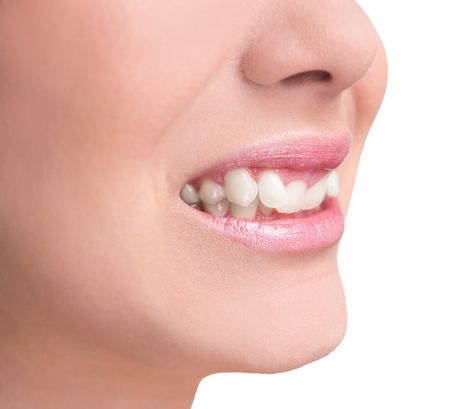 Overbites Linked To Oral Health Problems. An increased overbite is described as when the top row of teeth covers too much of the lower row of teeth. Overbites are caused by the relative shapes and sizes of the upper and lower jawbones. Your dentist can tell you if you have an overbite that might be causing problems.  Tooth Wear An... Overbite Teeth, Teeth Covers, Front Teeth, Jaw Bone, Good Health Tips, Oral Health, Health Problems, Design Inspo, Coming Out