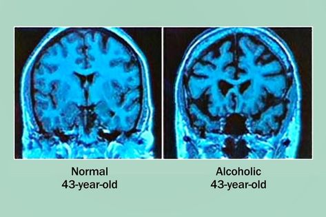 liver and kidneys anatomy Cross Sectional Study, Heavy Drinking, Alcohol Use Disorder, Effects Of Alcohol, Brain Scan, Basic Facts, Brain Damage, Mental Disorders, Do Exercise