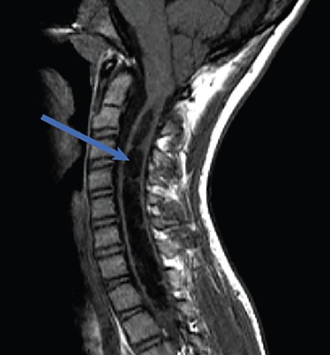 Understanding Chiari Malformation Comorbidities - Practical Neurology Chiari Malformation Type 1, Spinal Cord Syndromes, Chiari Malformation, Spinal Injury, Back Injury, Brain Fog, Neurology, Neck Pain, Physical Health