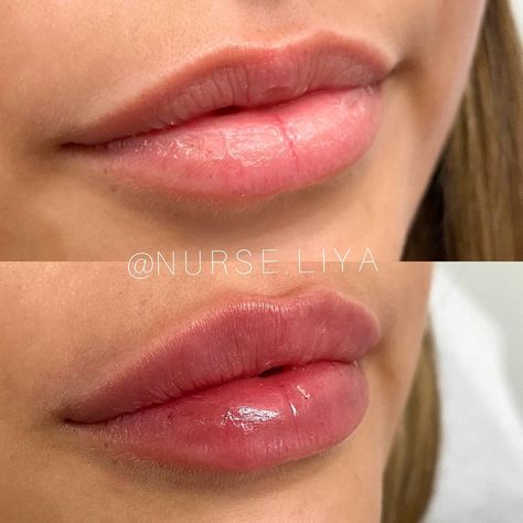 Lip Filler 2 Syringe, Natural Lips Filler, Hyaluronic Lip Fillers, Full Syringe Lip Filler, Natural Looking Lip Injections, Lip Filler One Syringe, Russian Lips Filler Natural, Small Lip Injections, Full Syringe Lip Filler Before And After