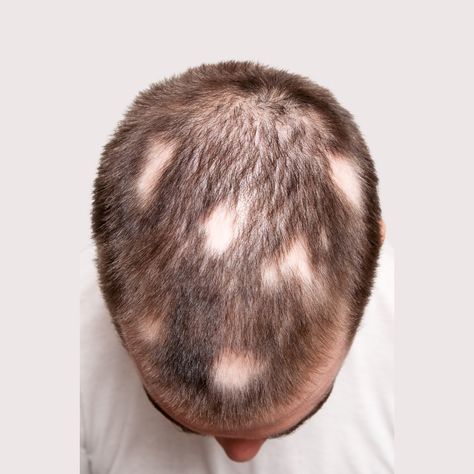 ❓ Can a person with alopecia get a hair transplant? The answer is more complex than a simple yes or no. Let’s break it down: 1. Androgenetic Alopecia (Pattern Baldness): Yes, this is the most common form of hair loss, and a hair transplant is often an effective solution. Research shows that hair transplants in patients with androgenetic alopecia have high success rates. 2. Alopecia Areata (Autoimmune Alopecia): This type is unpredictable. Hair transplants may not be ideal because the immune... Scarring Alopecia, Alopecia Universalis, Androgenetic Alopecia, Pattern Baldness, Yes Or No, Hair Restoration, Hair Transplant, Hair Follicle, Facial Hair