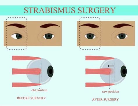 Orbit Eye Center is a leading pediatric ophthalmology center equipped with the latest technologies for strabismus surgery in Dubai. Strabismus Surgery, Eye Clinic, General Anaesthesia, Eye Center, Surgery Center, Anatomy Physiology, After Surgery, Anatomy And Physiology, Cool Eyes