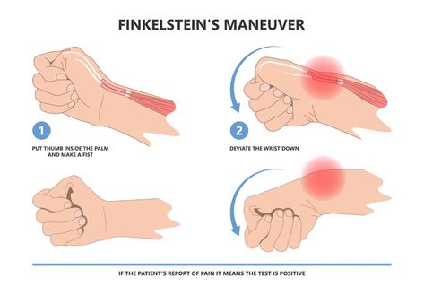 This test you can easily do yourself to see if you likely have De Quervain’s Tenosynovitis is often referred to as 'Finkelstein's Test' but is actually 'Eichhoff’s Test' Wrist Anatomy, Nbcot Exam, Physical Therapy Student, Rotator Cuff Tear, Medical School Life, Hand Exercises, Hand Therapy, Rotator Cuff, Thai Massage