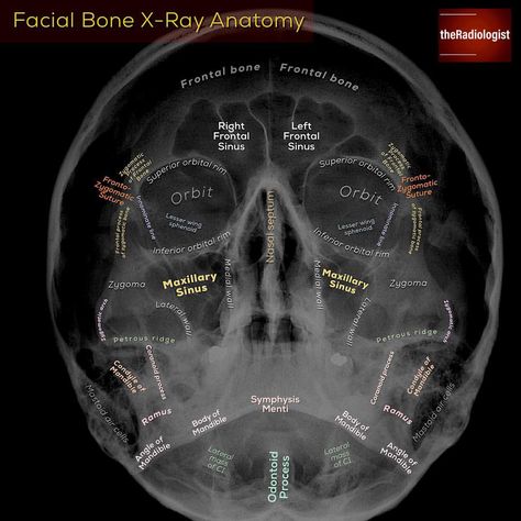 👨🏽‍💻Occipito-mental radiograph of the facial bones⁣ ⁣ 👨🏽‍💻The facial bone X-ray can be a confusing one to assess with so much opportunity… Xray Anatomy, Radiographic Positioning, Skull Xray, Radiography Student, Technology Student, Radiology Schools, Medical Radiography, Radiologic Technology, Radiology Student