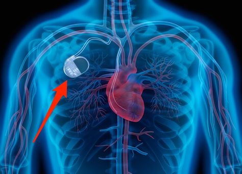 What Is a Pacemaker? Who Needs One and What to Expect From Surgery Sinoatrial Node, Cardiac Rhythms, Fatigue Symptoms, Parts Of The Heart, Heart Blocks, Heart Rhythms, Atrial Fibrillation, Heart Conditions, Heart Surgery