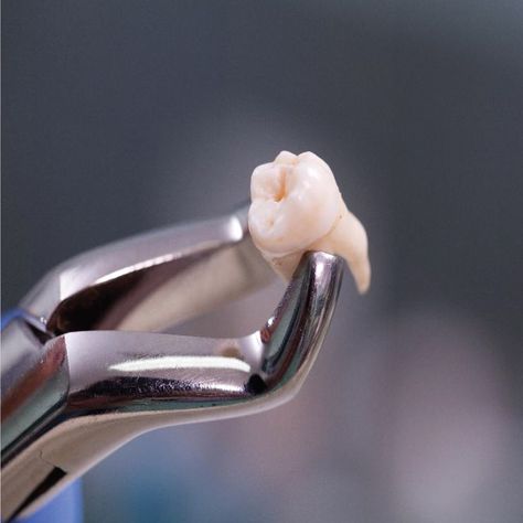 RECENT STUDIES show that a nanoscale view of tooth enamel could lead to a solution for enamel-regenerating tooth treatments! Tooth Extraction Aftercare, Dental Extraction, Sensitive Teeth Remedy, Wisdom Tooth Extraction, Dental Implants Cost, Wisdom Teeth Removal, Tooth Removal, Pediatric Dental, Teeth Implants