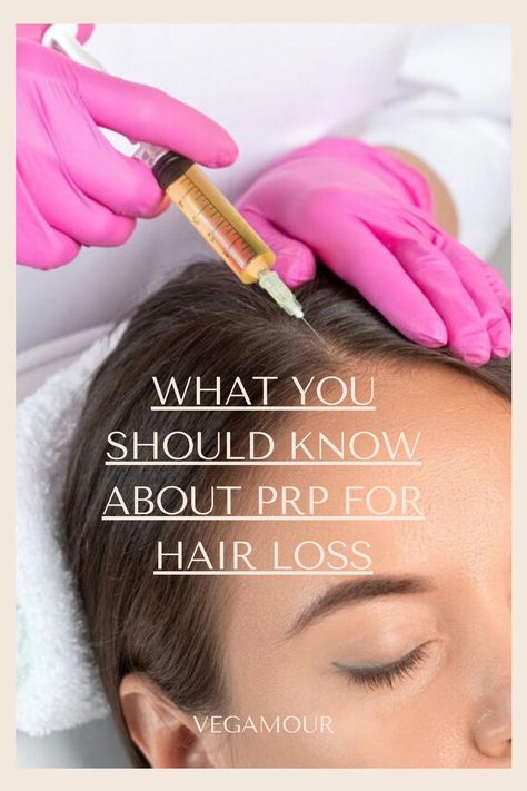 #EstrogenHairLoss #NaturalHerbsForHairLoss Prp For Hair, Natural Hair Growth Remedies, Prp Hair, Androgenetic Alopecia, Platelet Rich Plasma, Brown Spots On Face, Hair Remedies For Growth, Home Remedies For Hair, Lost Hair