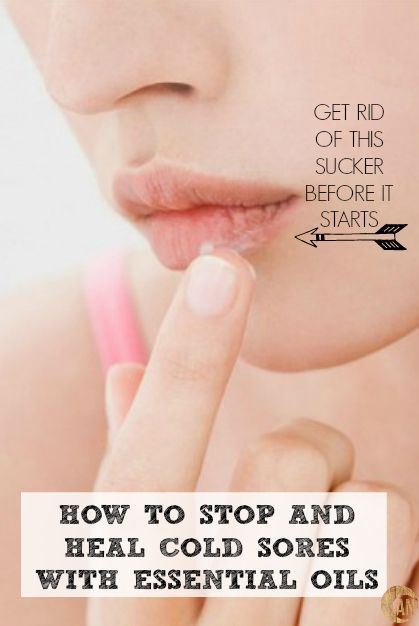 How To Stop and Heal Cold Sores with Essential Oils - must try this the next time I feel one coming on Tea Tree Oil For Cold Sores, How To Stop A Cold Sore Before It Starts, Lysine For Cold Sores, Essential Oils For Cold Sores, Cold Sore Essential Oil, Oregano Tea, Remedy For Cold, Ancestral Nutrition, Essential Oils For Colds