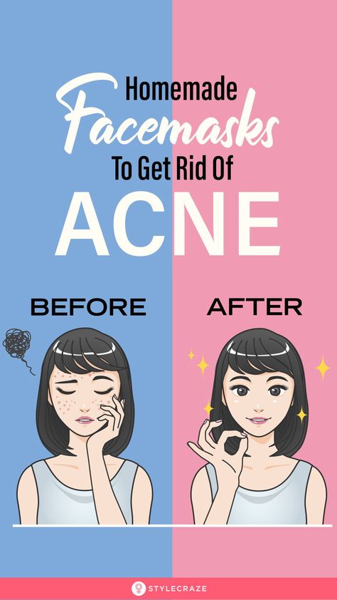 Face Mask For Pimples, Pimple Free Skin, Homemade Face Pack, Forehead Acne, Acne Free Skin, Acne Skincare, Diy Acne, Get Rid Of Acne, Rid Of Acne