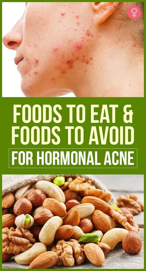 Foods To Eat And Foods To Avoid For Hormonal Acne: The changes could be something as simple as meditating for ten minutes daily to destress or something big like changing the fabrics you use or getting a good face wash. So in this article, we’re going to cover one such lifestyle change you can make- changing your diet. So here is a list of food items to eat and those to avoid. #hormonalacne #acne #beauty #beautytips Good Face Wash, Anti Acne Diet, Food For Acne, Acne Beauty, List Of Food, Acne Diet, Good Face, Foods For Healthy Skin, Skin Diet