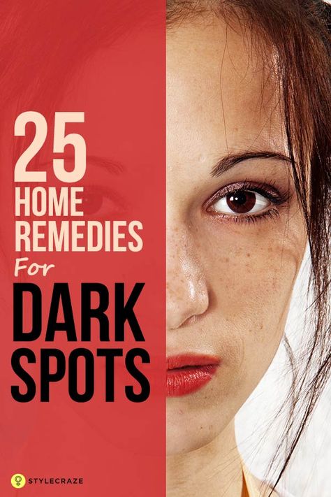 Dark spots (also known as age spots or black spots) on the skin can be annoying. Instead of covering them with makeup, know how to get rid of dark spots naturally using the above-listed home remedies. Have a look! Black Spots On Face, Sunspots On Face, Brown Spots On Hands, Brown Age Spots, Brown Spots On Skin, Oily Skin Acne, Skin Care Routine For 20s, Dark Spots On Face, Brown Spots Removal