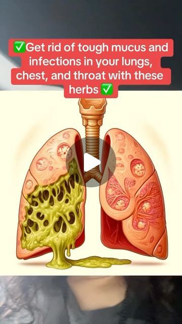 Remedies For Mucus In Throat, Remedies For Mucus In Chest, Mucus In Lungs Remedies, Mucus In Chest, Remove Mucus From Lungs, Foods For Mucus Relief, Lung Remedies, Cleanse Lungs, Lung Exercises For Pneumonia