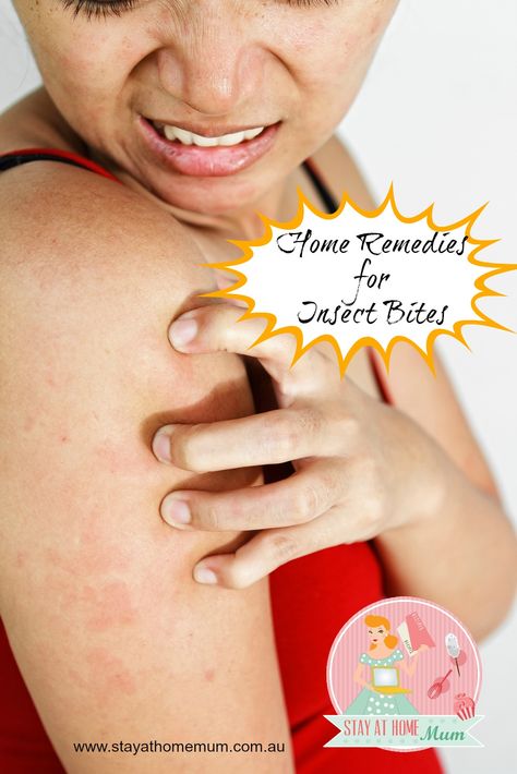 Home Remedies for Insect Bites | Stay at Home Mum Insect Bites Remedies, How To Get Rid Of Misquote Bites, Natural Remedies For Hives, Stop Itching Skin Insect Bites, Natural Itch Relief For Bug Bites, Herbal Bug Bite Remedy, Allergy Remedies, Keratosis Pilaris, Health Class