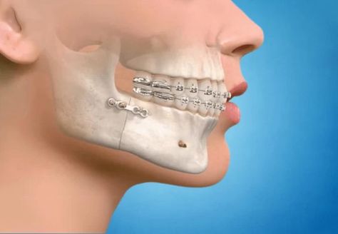 Maxillofacial Surgery Corrective Jaw Surgery, Impacted Tooth, Maxillofacial Surgery, Oral Maxillofacial, Jaw Surgery, Gastrointestinal Disease, Facial Surgery, Types Of Surgery, Pulmonology