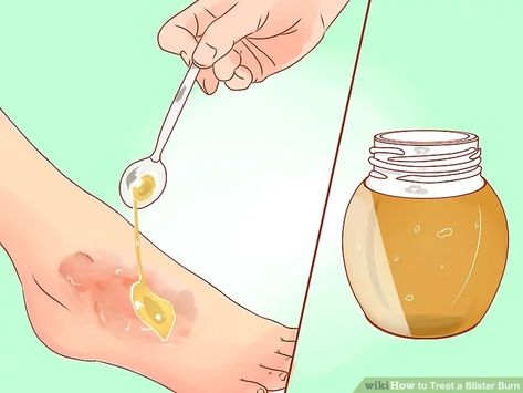 3 Ways to Treat a Blister Burn - wikiHow How To Treat Blisters, Skin Blisters, Treat Burns, Wounded Healer, Honey Benefits, Health Guide, Manuka Honey, Layers Of Skin, Emergency Medical