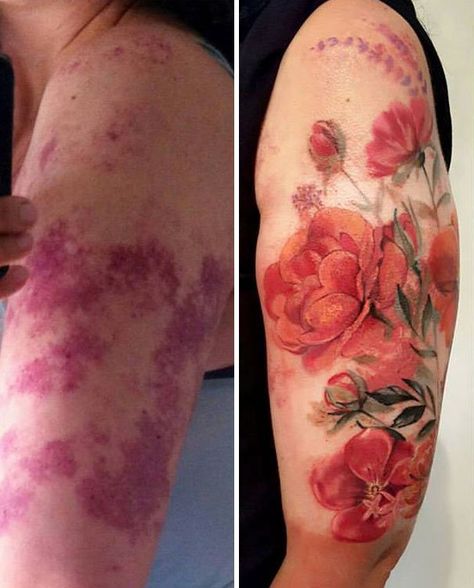 Port Wine Stain Birthmark Tattoo, Birthmark Tattoo Coverup, Tattoo Covering, Birthmark Tattoo, Independent Tattoo, Port Wine Stain, Wine Stain, 12 Tattoos, Stunning Tattoos