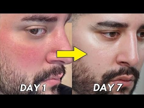 (9) How I healed My Broken Skin Barrier In 7 Days - YouTube Broken Skin Barrier, Ceramide Serum, I Healed, Beekman 1802, Skin Barrier, Life Hacks, Serum, Milk, Healing