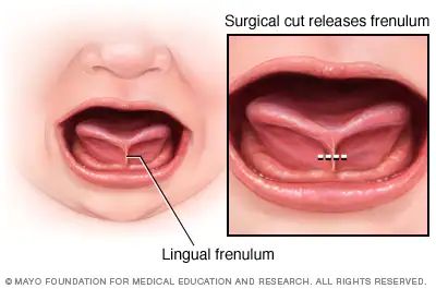 Tongue-tie (ankyloglossia) - Symptoms and causes - Mayo Clinic Tongue Health, Tongue Tie, Lactation Consultant, Oral Health Care, Mayo Clinic, Dental Health, Speech And Language, Oral Health, Speech Therapy