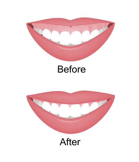 Botox Pictures, Gummy Smile Aesthetic, Gummy Smile Botox Before And After, Gummy Smile Correction, Filler And Botox Quotes, Botox Instagram Post, Botox Aesthetic Instagram, Botox Aesthetic, Botox Quotes Posts