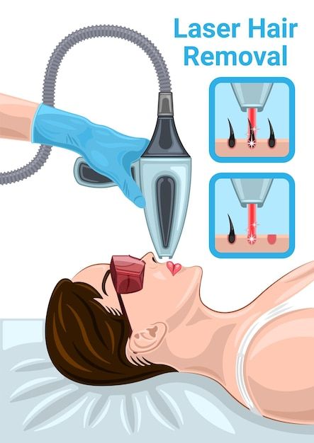 Hair Removal Face, Laser Hair Removal Face, Skin Care Procedures, Hair Laser, Woman Cartoon, Hair Illustration, Animation Cartoon, Beauty Academy, Botox Injections