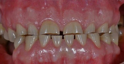 Dental Attrition of particular Teeth may be Due to Bad Biting habits as nail biting Pencil Biting and Other malocclusion issues Dental Pictures, Cosmetic Dentistry Veneers, Dental Hygiene Student, Night Guard, Dental Anatomy, Dental School, Dental Office Design, Dental Humor, Strange Photos