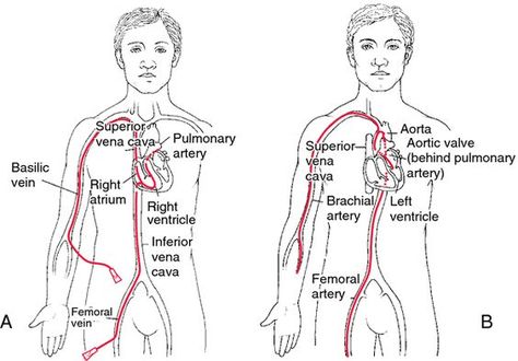 Definition of Left-sided cardiac catheterization in the Medical Dictionary by The Free Dictionary Cath Lab Nursing, Urinary Catheterization, Cardiac Cath, Cath Lab Nurse, Heart Catheterization, Central Venous Catheter, Cardiac Sonography, Vascular Ultrasound, Radiology Student