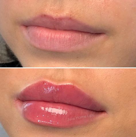 Lip Filler Reference Photos, Natural Looking Lip Injections, Natural Russian Lips, Lip Fillers Natural Look, .5ml Lip Filler, Julie Horne Lip Filler, Lip Filler Lips, Kysse Lips Filler, Lip Botox Natural