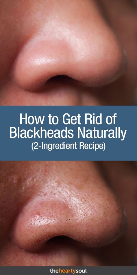 Black Head Removal Video Nose, Natural Blackhead Remover, Diy Pore Strips, Skincare Blackheads, Homemade Pore Strips, Blackheads On Face, 2 Ingredient Recipes, Pimples Under The Skin, Face Health