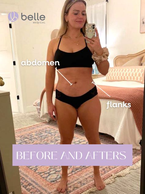 See before and afters! Fat Transfer, Stretch Mark Cream, Makeover Before And After, Stretch Mark Removal, Mommy Makeover, Iv Therapy, Hormone Replacement, Stomach Fat, Fat Removal