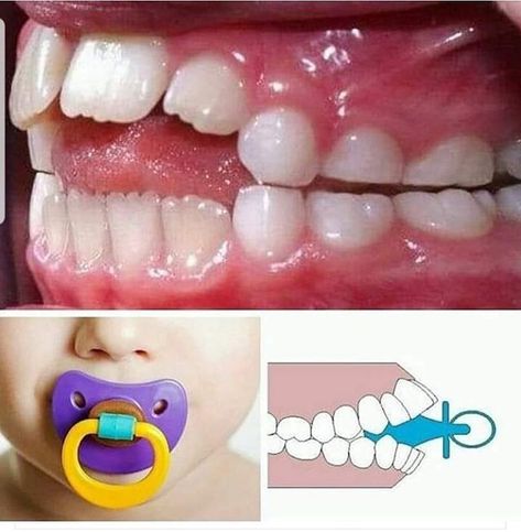 Anterior open bite caused by sucking a non orthodontic pacifier or thumb sucking beyond the age of 2 years. If your child had an anterior open bite we can correct it with the magic of orthodontics. Call us on 021 696 9428 for more information or to book an appointment Ortho Marketing, Orthodontics Marketing, Happy Dental, Dental Photos, Orthodontic Pacifier, Teething Pacifier, Veneers Teeth, Dental Kids, Emergency Dentist