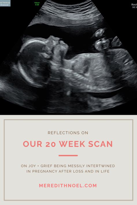 our 20 week scan: on joy + grief being messily intertwined in pregnancy after loss and in life. ~ meredith noel: a life that's good Pregnancy Scan, Med Doctor, 20 Week Scan, 21 Weeks Pregnant, Pregnancy After Loss, 20 Weeks Pregnant, Kids At Home, Overcome The World, Child Loss