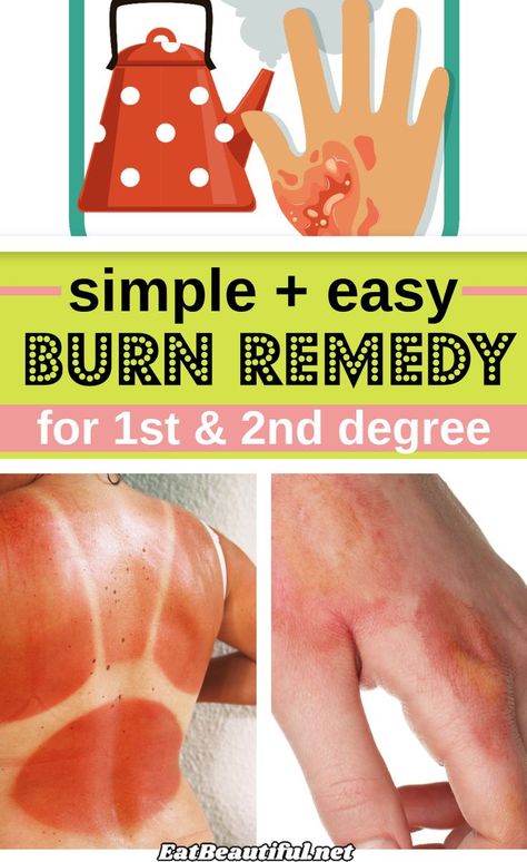 Learn the best home remedy for 1st and 2nd degree burns, including sunburns! — found in most home kitchens, and how and why to use it. 43% of all burns happen in the home... | Eat Beautiful | health | sunburn | remedy | how to | home | natural | burn | medicine | 1st degree | 2nd degree || #DIY #burn #remedy #natural #sunburn Sunburn Remedy, Home Remedies For Burns, 2nd Degree Burns, Home Remedies For Sunburn, Burn Remedy, Eat Beautiful, Sunburn Remedies, Severe Dry Skin, Degree Burns