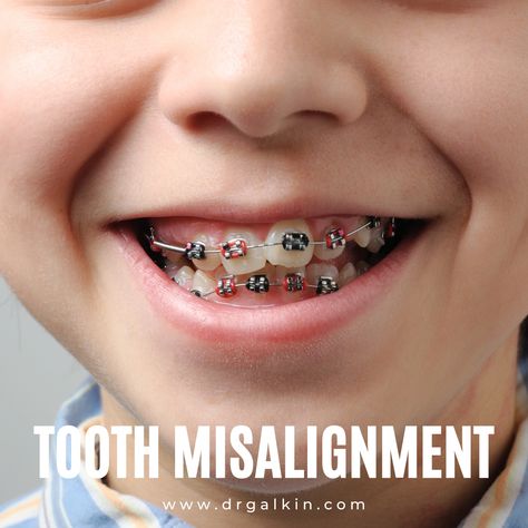 Teeth Alignment, Kids Dentist, Orthodontics Braces, Oral Care, Beautiful Smile, Braces, Quick Saves