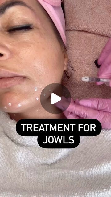 Xpress Aesthetics: AESTHETIC PRACTITIONER on Instagram: "These injections lift the lower face preventing the pull downwards   #antiaging #antiwrinkletreatment #antiwrinkle #skinhealthy #jowllift" Aesthetic Practitioner, Lower Face Lift, Face Injections, Botox Before And After, Botox Face, Thread Lift, Anti Wrinkle Treatments, Cosmetic Injectables, Cosmetic Procedures