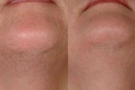 Homemade Hair Removal, Best Hair Removal Products, Hair Removal Methods, Lake Oswego, Facial Hair Removal, Hair Removal Permanent, Beauty Remedies, Hair Removal Cream, Hair Reduction