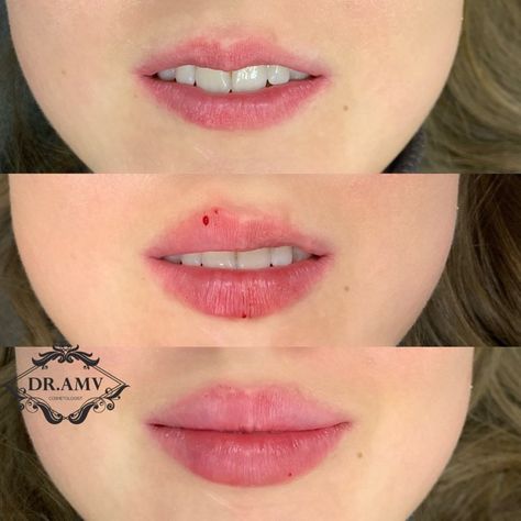 Lip Fillers Juvederm, Eye Lift Surgery, Face Plastic Surgery, Lips Fillers, Lips Shape, Lips Inspiration, Facial Routine Skincare, Botox Lips, Aesthetic Dermatology