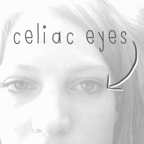 What I want you to know about celiac disease - inspiredrd.com Celiac Eyes, Celiac Awareness, Gluten Free Info, Coeliac Disease, Going Gluten Free, Gluten Free Living, Diastasis Recti, Gluten Sensitivity, Gluten Intolerance