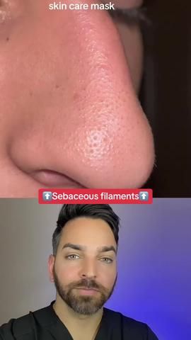 DermDoctor | Dr. Shah (@dermdoctor) Official | TikTok Mask For Dark Spots, Chemical Face Peel, Dr Shah, Black Head Remover, Sebaceous Filaments, Glycolic Acid Peel, Clear Skin Routine, Acid Peel, Pore Strips