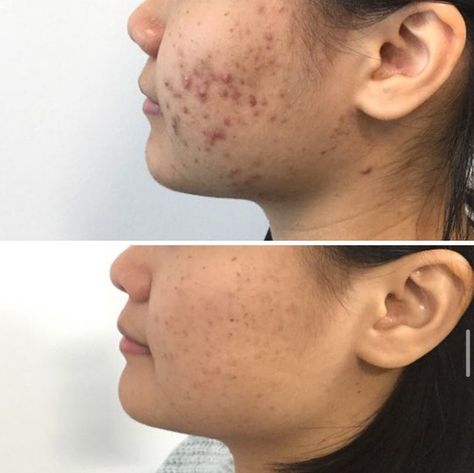 Facial Before And After, Before And After Acne, Back Acne Remedies, Acne Laser, Face Mapping Acne, Natural Acne Remedies, Great Skin, Aesthetic Clinic, Face Acne