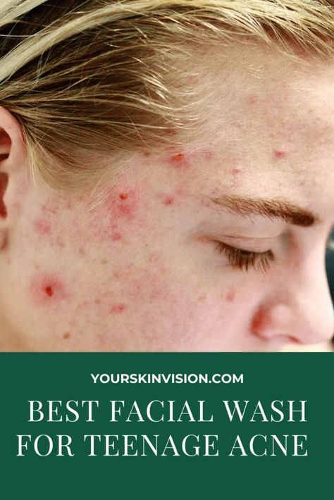 5 Best Facial Wash for Teenage Acne in 2023 - YourSkinVision Face Wash For Oily Skin Acne, Skin Care For Teenage Acne, Youth To The People Face Wash, Zapzyt Acne Wash, Teenage Acne Skincare Routine, Acne Scrub, Acne Cleanser, Treating Cystic Acne, Teenage Acne