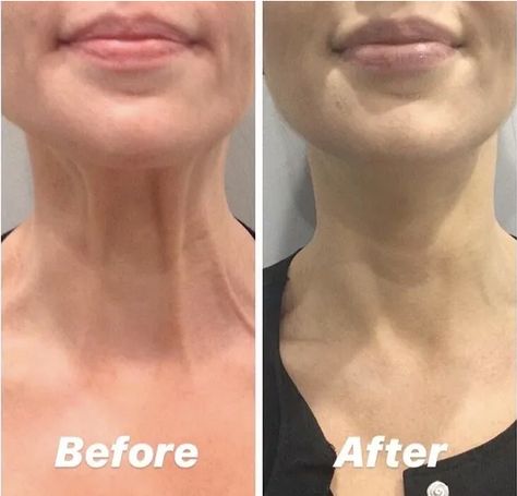 Neck Fillers Before And After, Wrinkles Before And After, Botox In Neck, Botox Neck Before After, Neck Botox Before And After, Neck Rejuvenation, Loose Neck Skin, Medi Spa, Neck Tightening